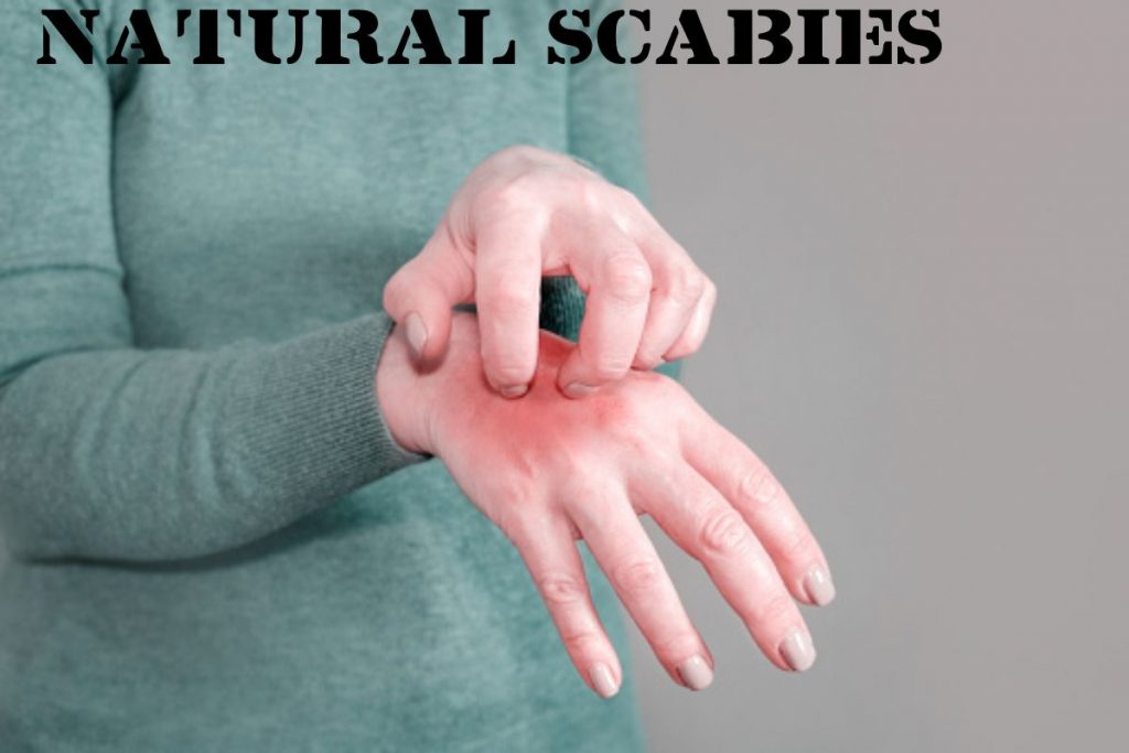Natural Scabies