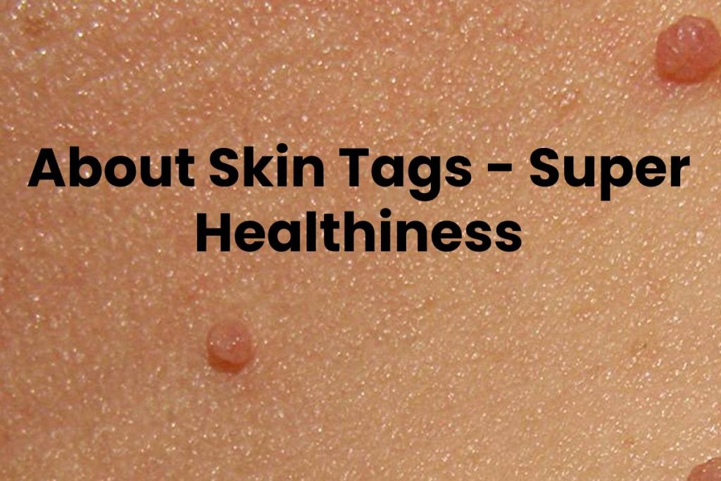 About Skin Tags - Super Healthiness