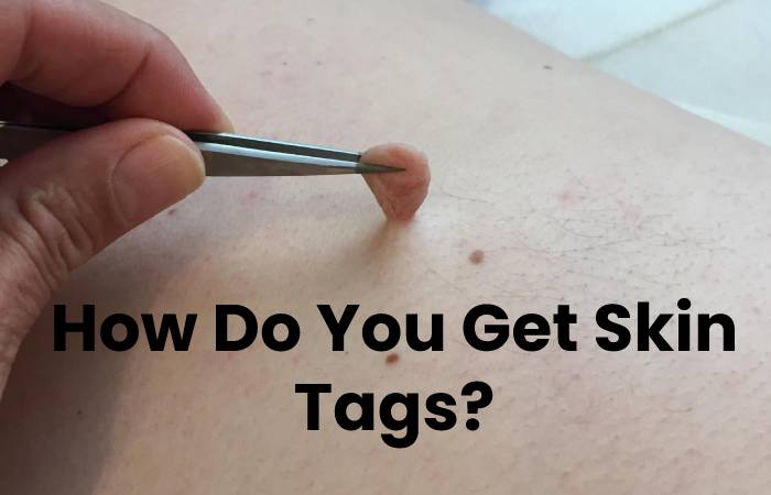 How Do You Get Skin Tags?