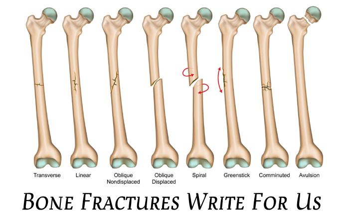 Bone Fractures Write For Us