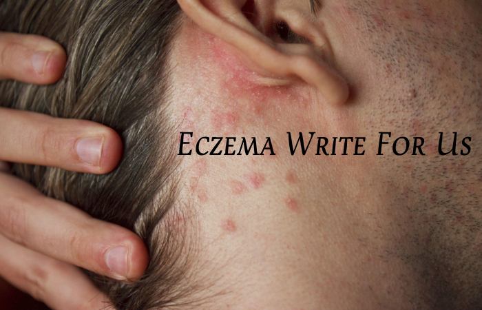Eczema Write For Us