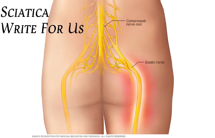 Sciatica Write For Us