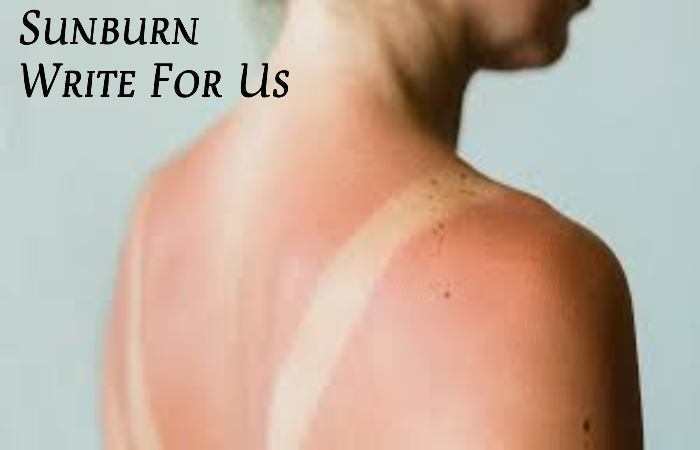 Sunburn Write For Us